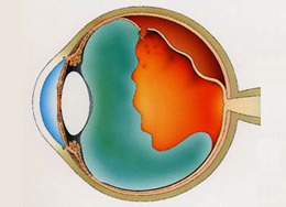 網膜剥離のイメージ（断面図）