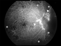 蛍光眼底造影（左眼底写真と同じ症例） 血管閉塞（※）と新生血管（▽）